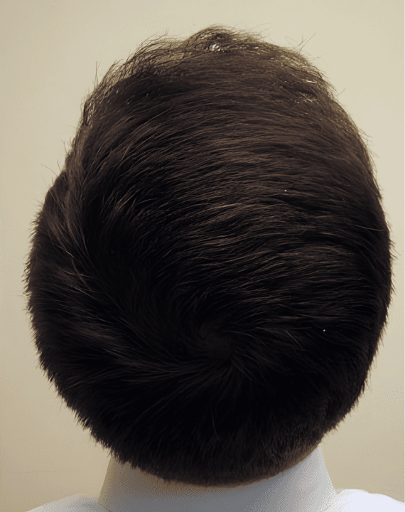 After – Crown Restoration