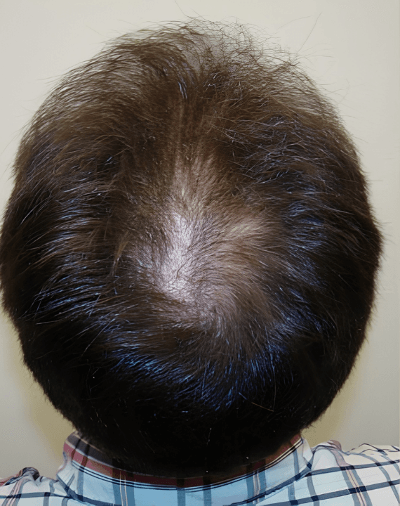 Before – Crown Restoration