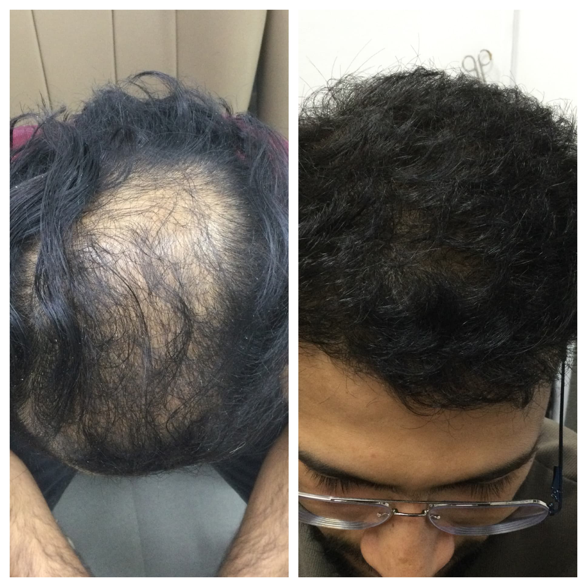 Post-treatment natural hairline result