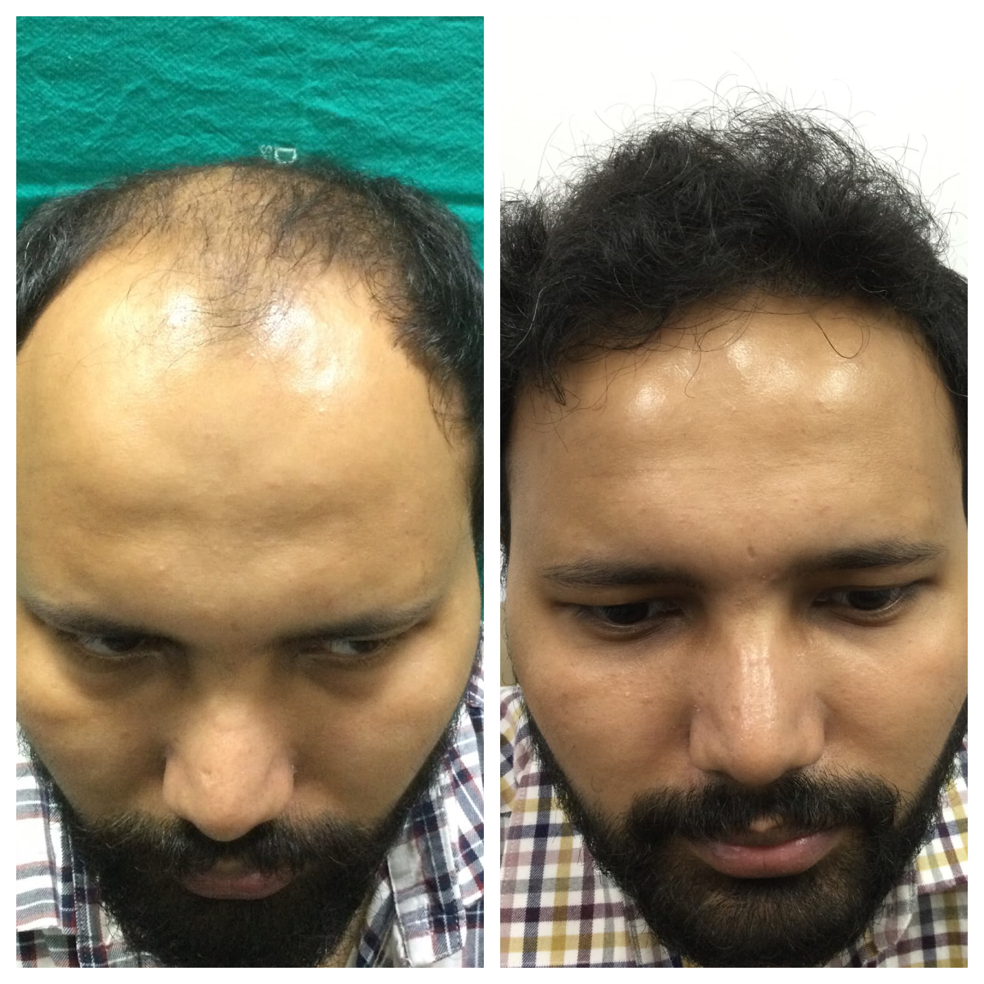Pre-treatment hairline assessment