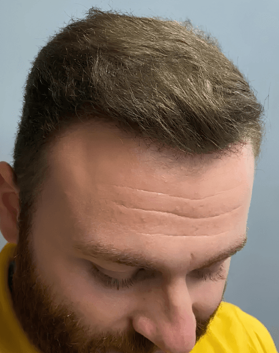 After – Hairline Design
