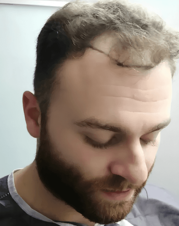 Before – Hairline Design